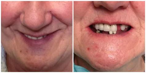 Immediate Complete Upper And Lower Dentures Vernon Denture Clinic