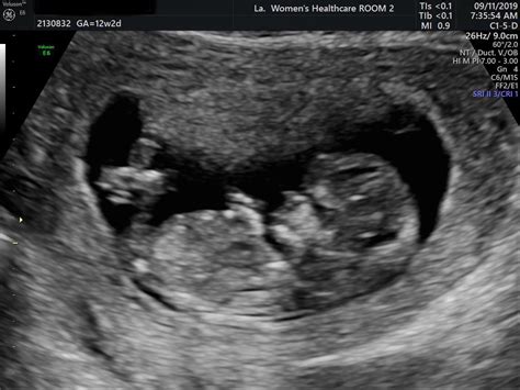 12 Week Ultrasound Moving Around Like Crazy During It Rpredaddit