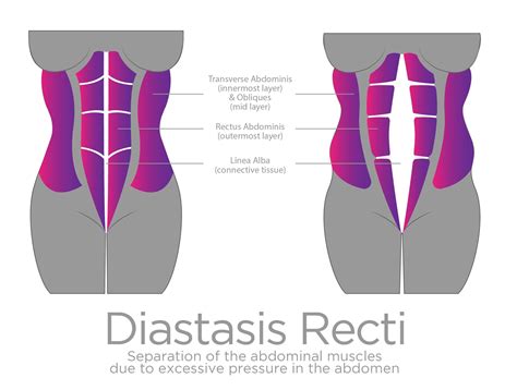 Latest Scientific Research On Diastasis Recti The Belle Method