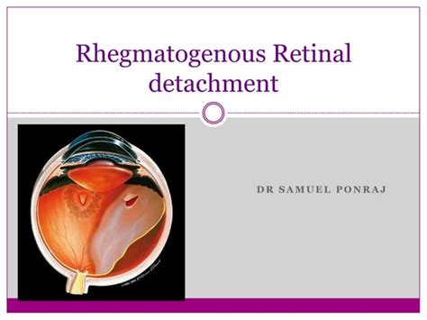 Retinal Detachment Causes And Treatment Ppt