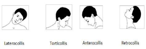 Torticolis Congénita Qué Es Causas Síntomas Tratamiento Y Consejos