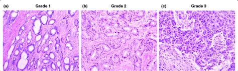 Histological Grade Of Breast Cancer As Assessed By The Nottingham