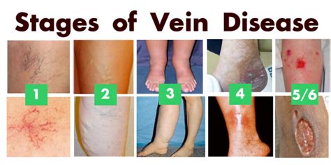 The Stages Of Vein Disease St Louis Laser Veins