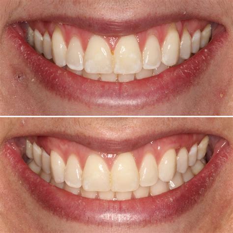 Esthetic Periodontics And Gum Grafting Meridian Periodontics And Dental