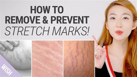 How To Get Rid Of Stretch Marks Fast Natural Remedies For Stretch
