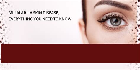 Milialar A Skin Disease Everything You Need To Know Discoverycentre