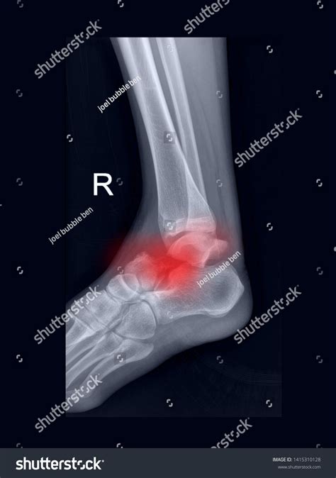 Film Foot Xray Radiograph Showing Ankle Stock Photo 1415310128