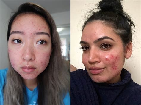 Furthermore, it affects various parts of the body including. 6 YouTube Beauty Stars Share the Advice That Helped Them ...