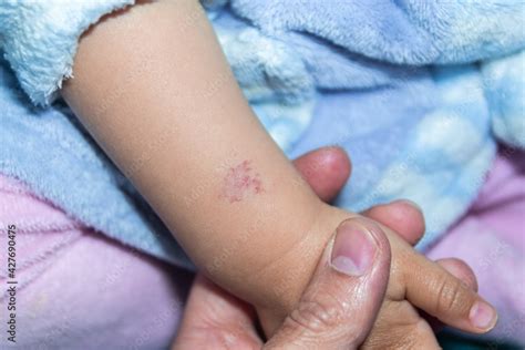 Angioma Or Pink Hemangioma On The Arm Of A Fifteen Month Old Baby Foto