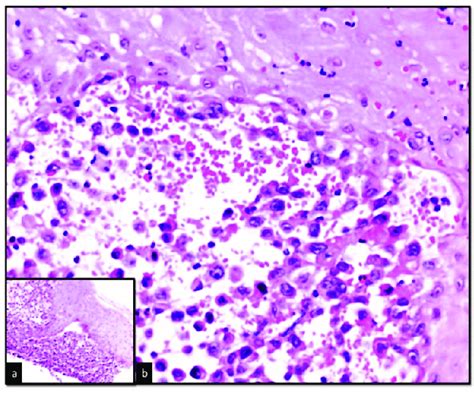 Histopathological Examination Of The Polypoid Lesion Showing Under The
