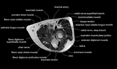 Plantaris can have variable size, but in most cases is difficult to demonstrate on routine mri studies. mri anatomy elbow - Google Search | MRI | Pinterest | Anatomy