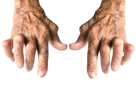 Specific Atp Type Critical To Inflammatory Spread In Rheumatoid Arthritis