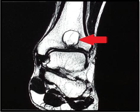 Intraosseous Ganglion Cyst Of The Distal Tibia A Rare Entity In A