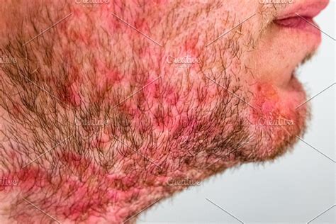 Man With Seborrheic Dermatitis In Th Featuring Seborrheic Dermatitis