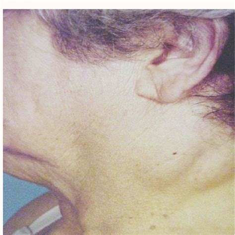 Clinical Appearance Of Left Neck Swelling Seven Years After Initial