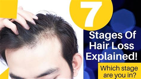 Male Pattern Baldness Stages How Do You Know If You Have Baldness