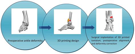 3d Printing Assisted Supramalleolar Osteotomy For Ankle Osteoarthritis