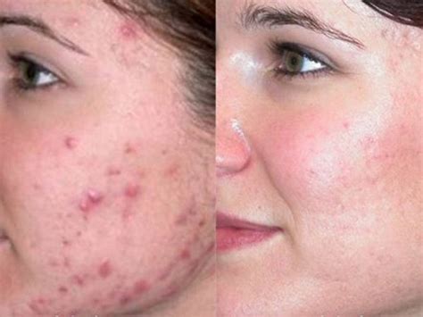 How To Get Rid Of Cheek Acne Amjad Medical