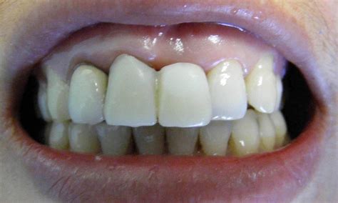 Dental Implant For Front Tooth And Crown For Front Tooth Before And After