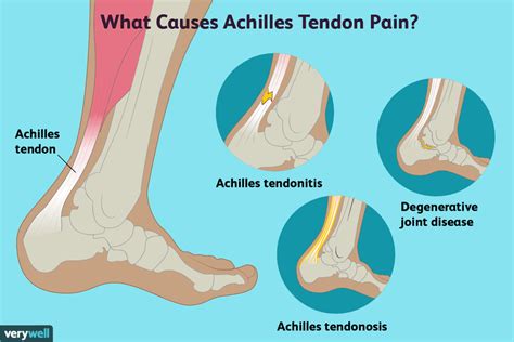 Achilles Tendon Pain Causes Treatment And When To See A Healthcare