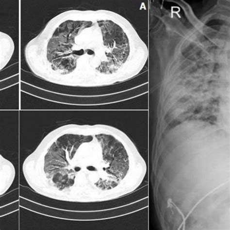 A Hrct Thorax Showing Multiple Air Filled Cystic Spaces Red Arrow