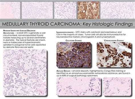 Medullary Thyroid Carcinoma Pathology Iowa Head And Neck Protocols