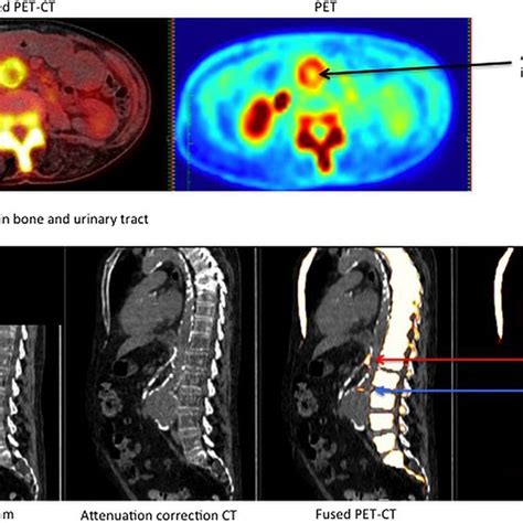 18f Naf Positron Emission Tomographycomputed Tomography Pet Ct In