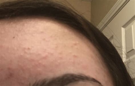 Is This Acne Or Malassezia Folliculitis Pictures Included General