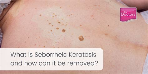 Seborrheic Keratosis Removal The Doctors Laser Clinic