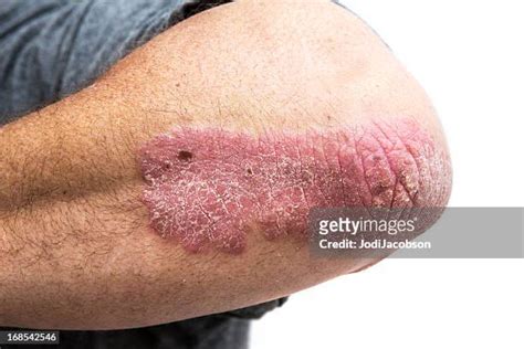 Psoriasis Elbow Photos And Premium High Res Pictures Getty Images