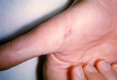 Rabies Infected Bite