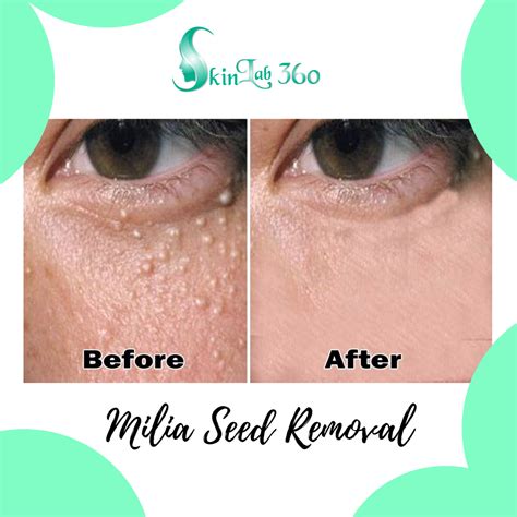 Milia Seedskin Tag Removal Skin Lab 360™
