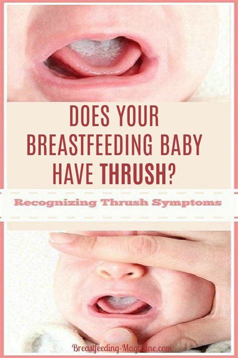 Recognizing Thrush Symptoms When Breastfeeding And Treatment Options