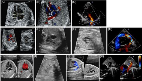 The Prenatal And Postnatal Echocardiogram Images Of Different Types Of