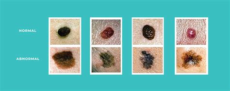 Skin Cancer Ferrara Dermatology