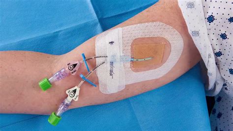 A picc line requires careful care and monitoring for complications, including infection and blood clots. Tegaderm™ CHG (1657) - Application & Removal for PICCs ...
