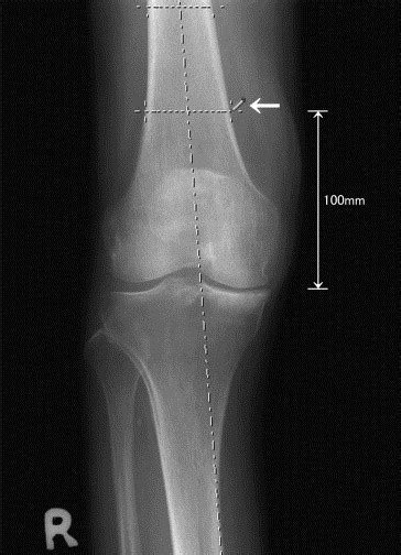 A New Computer Assisted Method For Measuring The Tibio Femoral Angle In
