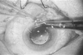 Image result for first plastic lenses were fitted for a cataract patient.