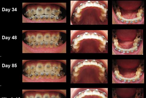 My Journey With The Damon Braces Progress For The Past 23 Weeks In