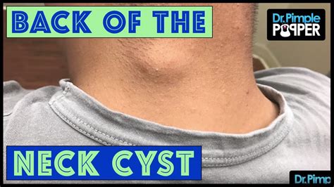 A Cyst We Cant Neck Lect Youtube