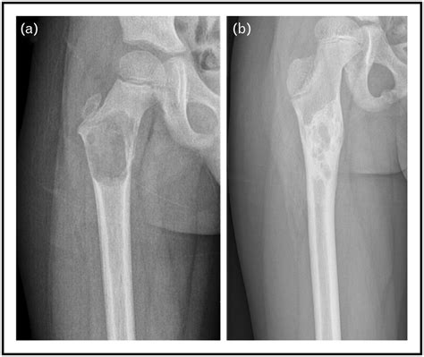 A An Aneurysmal Bone Cyst In The Right Proximal Femur Exhibiting