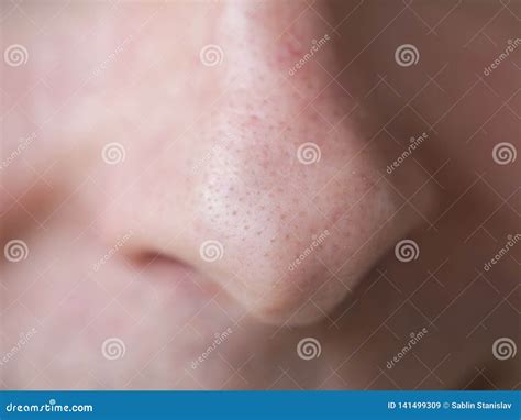 Pimple Blackheads On The Nose Close Up Stock Image Image Of Closeup