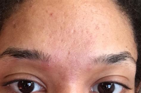 Skin Concerns Help Me With My Forehead Texture Large Pores And