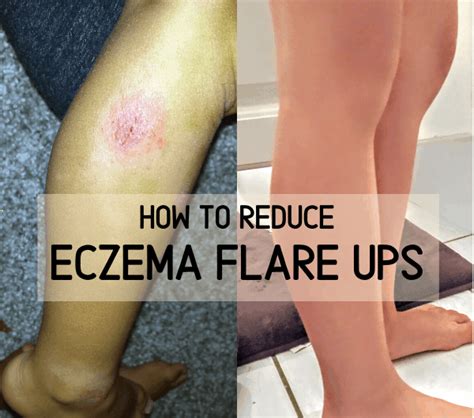 How To Prevent Eczema Flare Ups 5 Steps Atmytable