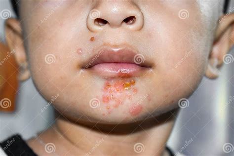 Staphylococcal Skin Infection Called Impetigo Around Mouth Stock Image