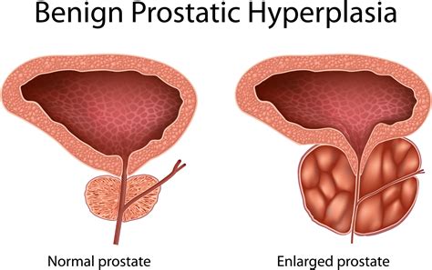 Holep An Efficient Procedure To Treat Enlarged Prostate