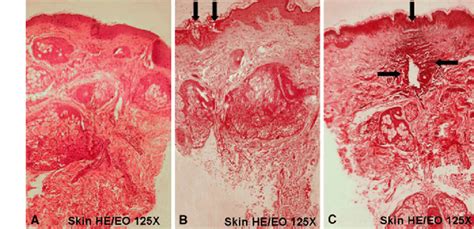 A Histologies Representing Skin Condition Hematoxylin Eosin Heeo