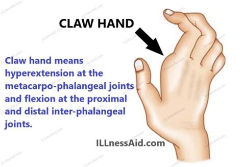 Claw Hand How Pt And Ot Can Help Illnessaid
