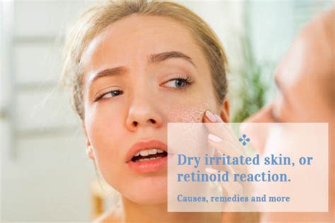 Dry Irritated Skin Or Retinoid Reaction Causes Remedies And More
