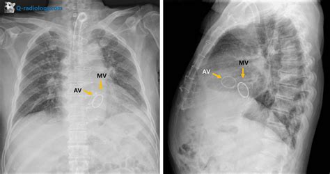Anatomy Of Valves On Chest X Rays Q Radiology